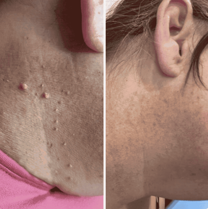 Precision Skin Tag Remover